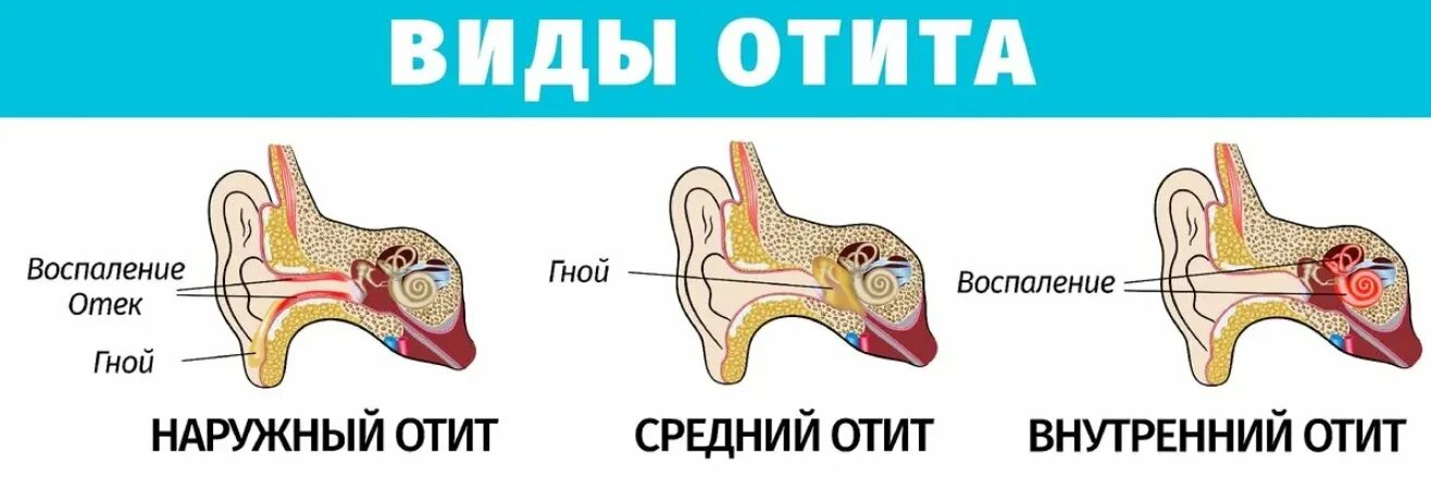 Острый Гнойный перфоративный отит. Как выглядит острый наружный отит. Острый наружный отит ухо.