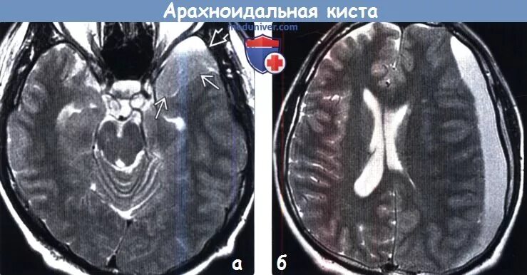 Снимок мрт головного мозга с кистой. Арахноидальная киста мрт. Арахноидальная киста эпифиза. Кистозные образования головного мозга на мрт. Как выглядит киста на мрт.