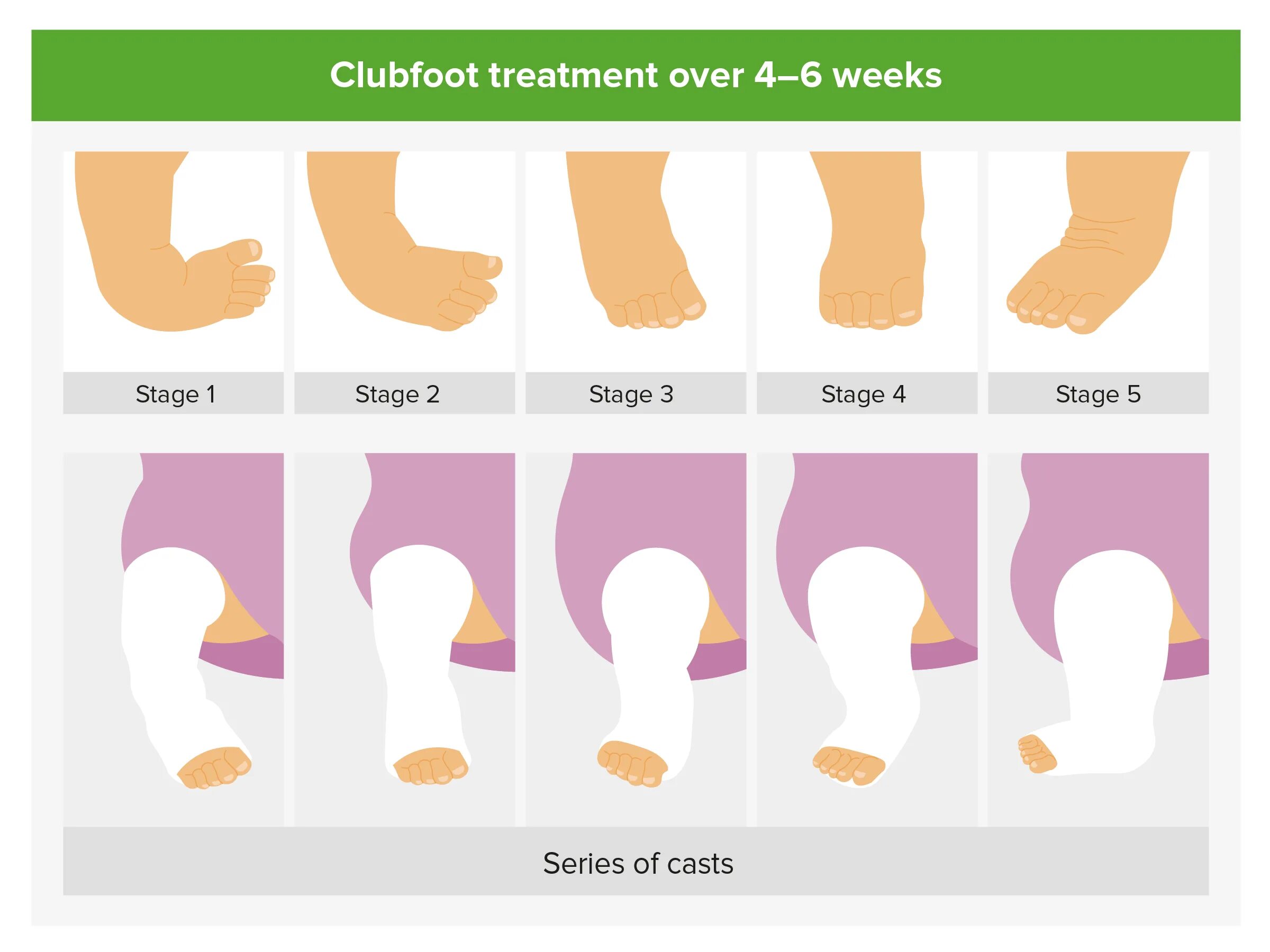 Club foot перевод. Club foot перевод. Club foot перевод. Клуб фута. Types of feet.