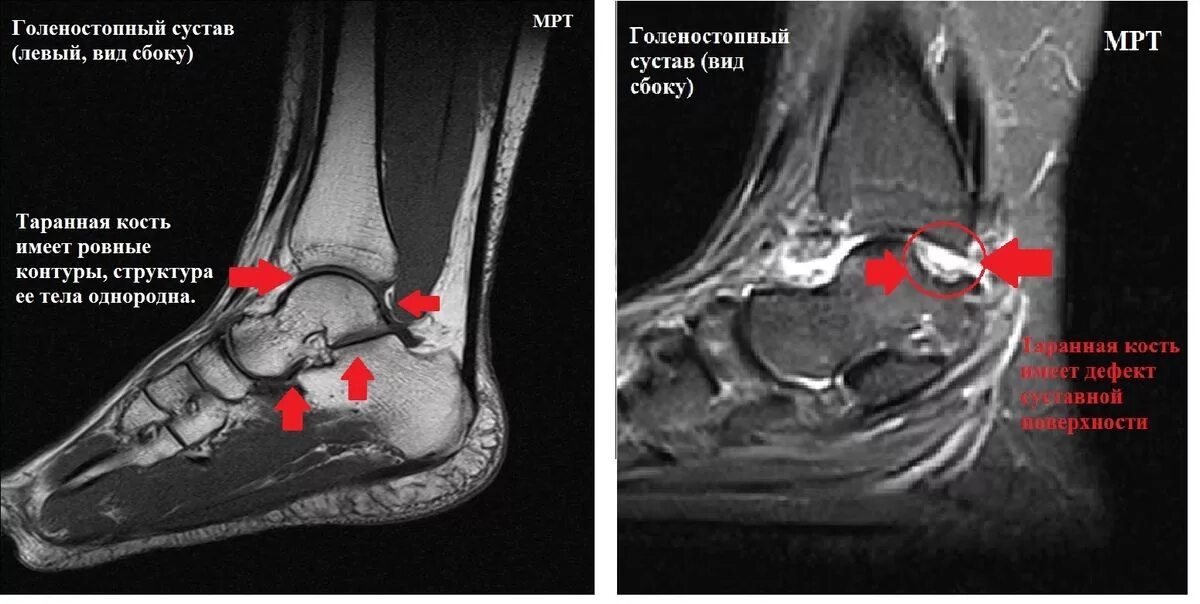 Диагноз голеностопный сустав. Мрт разрыв связок голеностопа. Мрт и кт голеностопного сустава. Подвывих голеностопного сустава на мрт. Синовит голеностопного сустава на мрт.