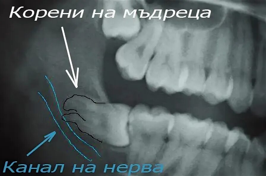 Лечат 8 зуб. Зуб мудрости 8ка верхний. Рецессивный зуб мудрости. Зуб 8 зуб мудрости верхний. Горизонтальное прорезывание зуба мудрости.