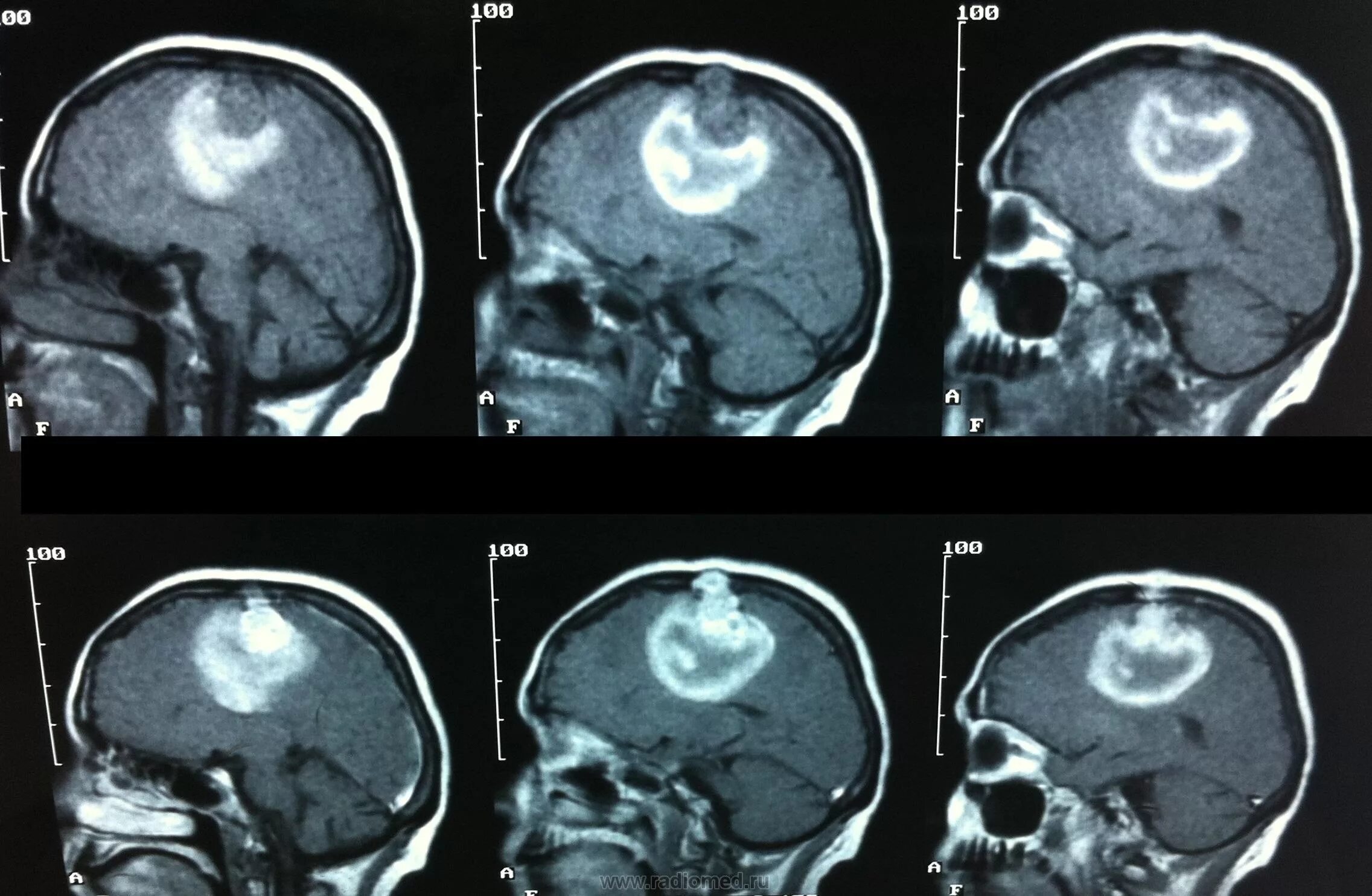 После операции менингиомы головного мозга. Менингиома кт ГМ. Менингиома лобной доли кт. Злокачественная менингиома кт. Атрофия ГМ кт.
