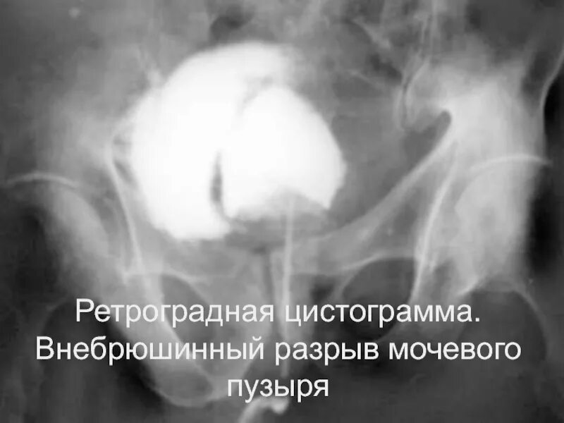 Внутрибрюшинный разрыв. Цистография разрыв мочевого пузыря. Внутрибрюшинный разрыв мочевого пузыря рентген. Цистография при разрыве мочевого пузыря. Травма мочевого пузыря рентген.