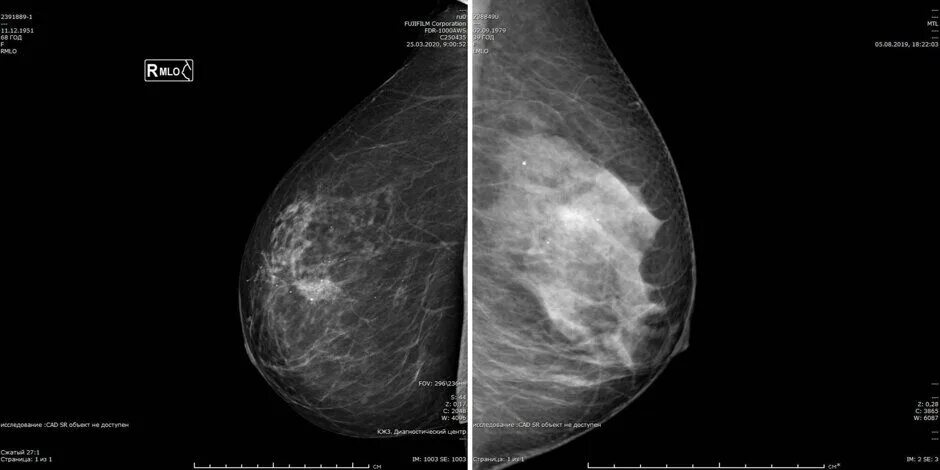 Микрокальцинаты в молочной железе на маммографии