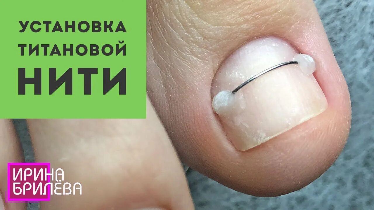 Как делают титановые ногти