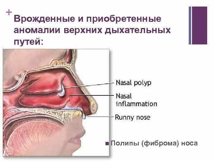 Сфеноидит симптомы у взрослых