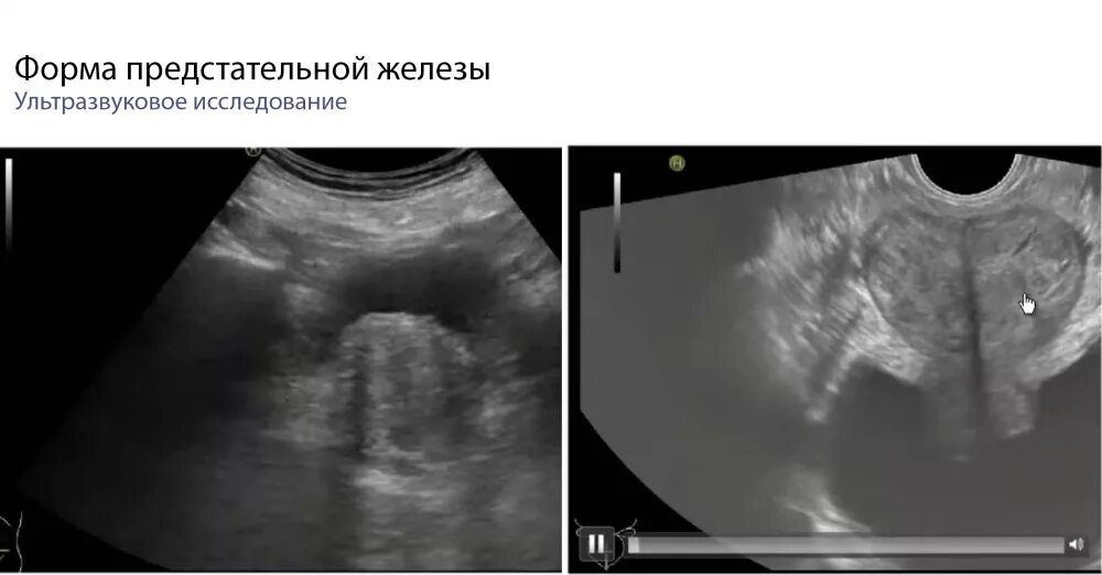 Дгпж узи. Трансректальное УЗИ простаты. УЗИ предстательной железы Изранов. Гиперплазия предстательной железы УЗИ.