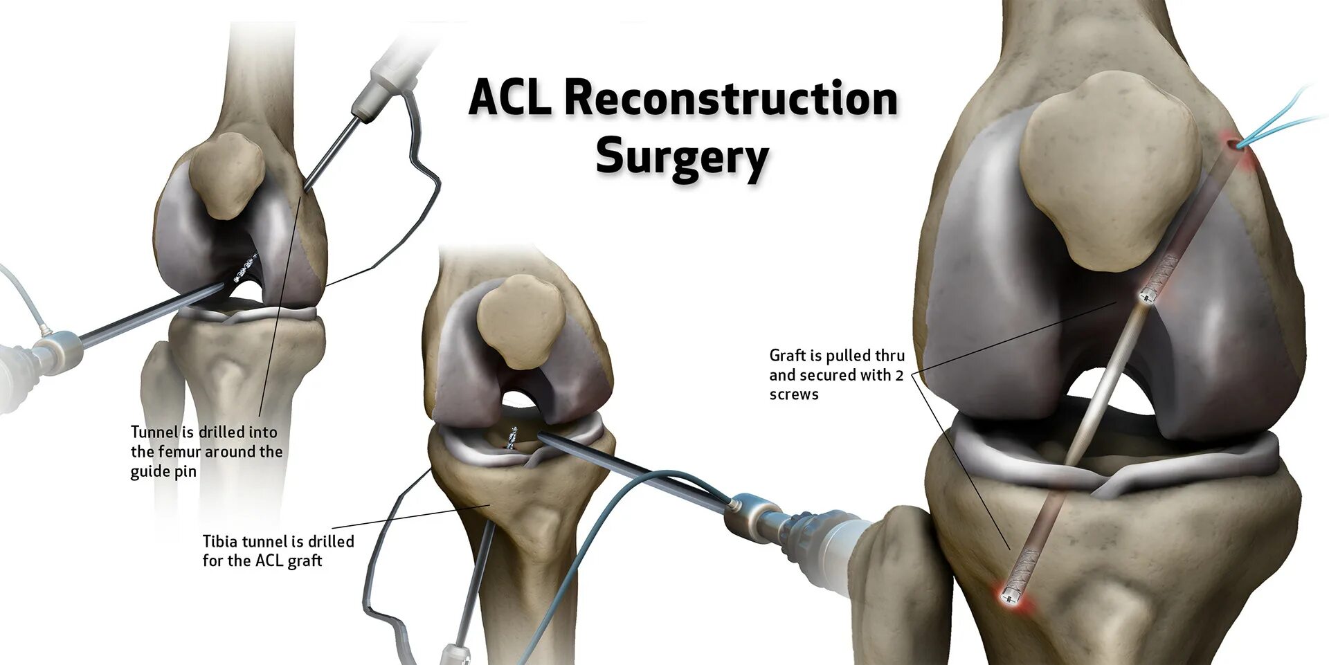 Acl что это. ACL Reconstr. Динамический ACL.