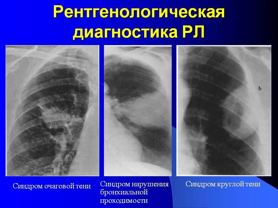 Основные признаки опухоли. Рентгенологические признаки фиброзного эпулиса. Изъязвленная опухоль желудка рентген. Центральная опухоль легкого. Опухоль в легких на рентгене.