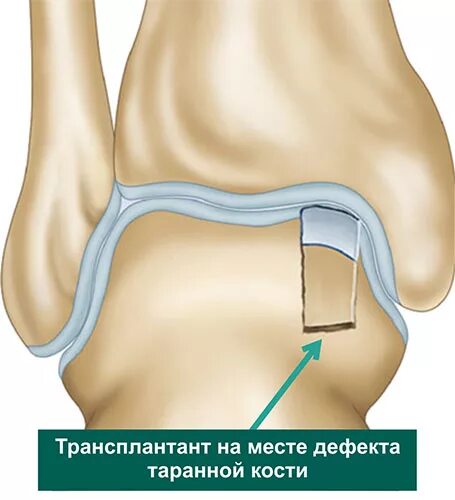 Трансплантант. Остеохондральный дефект таранной кости. Остеохондральный перелом надколенника. Костная пластика таранной кости. Остеохондральный перелом коленного сустава.