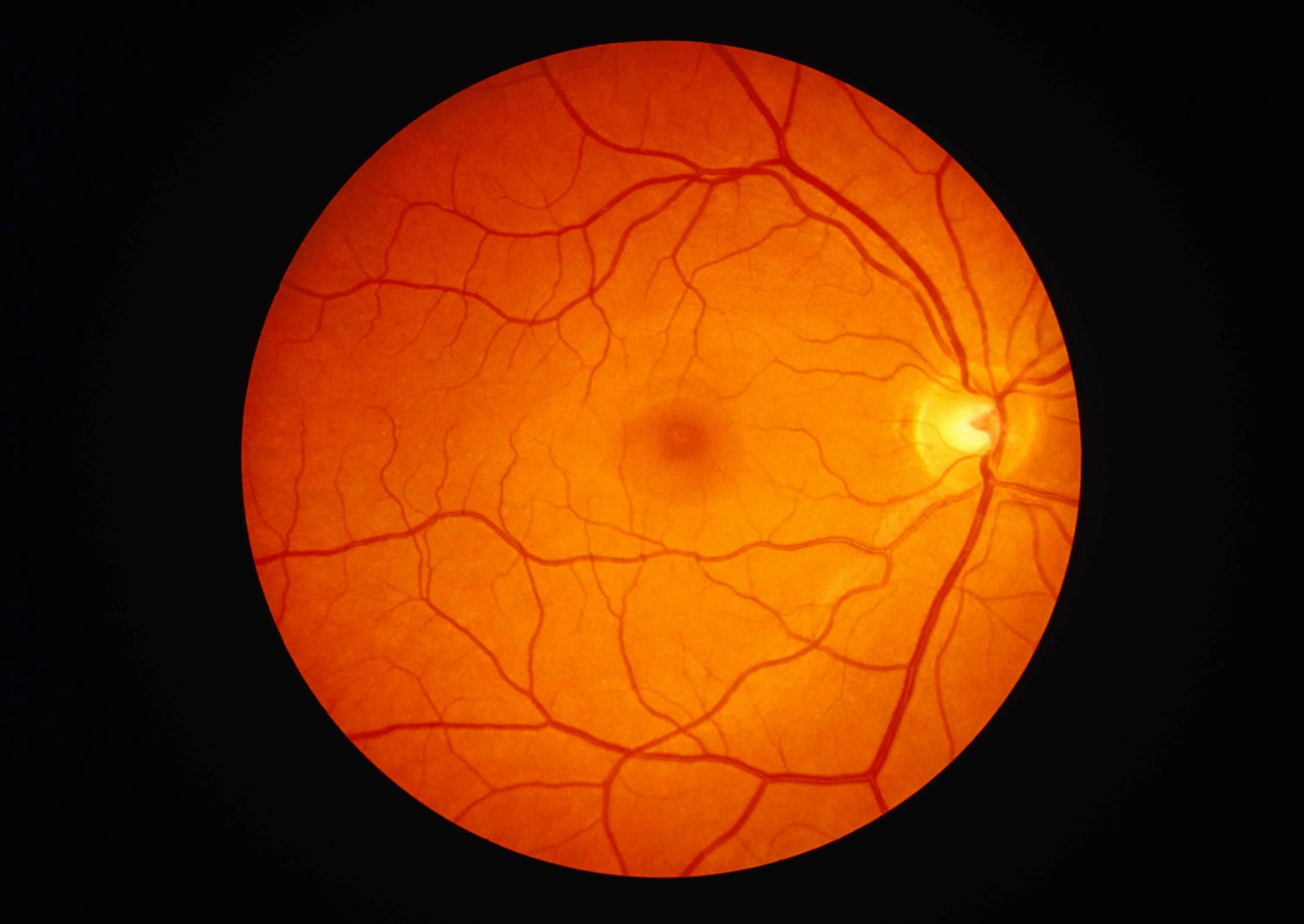 Глазное дно сетчатка глаза анатомия. Макула сетчатки анатомия. Пигментный ретинит сетчатки. Отслойка сетчатки глазное дно.
