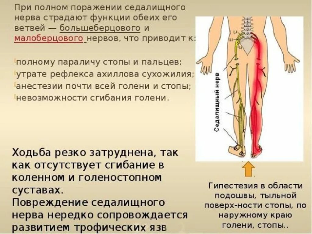 Как понять что болит седалищный нерв