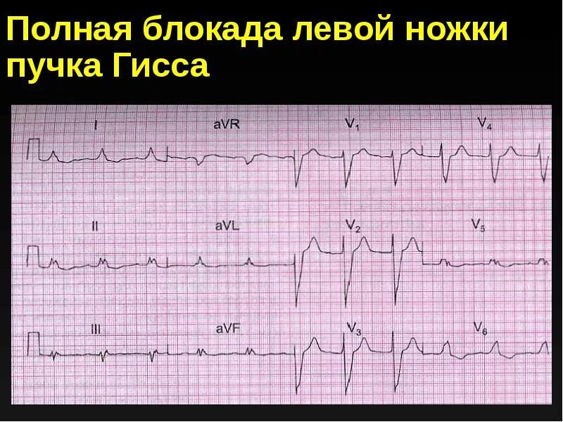 Полная блокада пучка ножки гиса лечение. Блокада левой ножки пучка Гиса на ЭКГ. ЭКГ при блокаде левой ножки пучка Гиса. Полная блокада левой ножки пучка Гиса на ЭКГ. ЭКГ полная блокада левой ножки пучка.