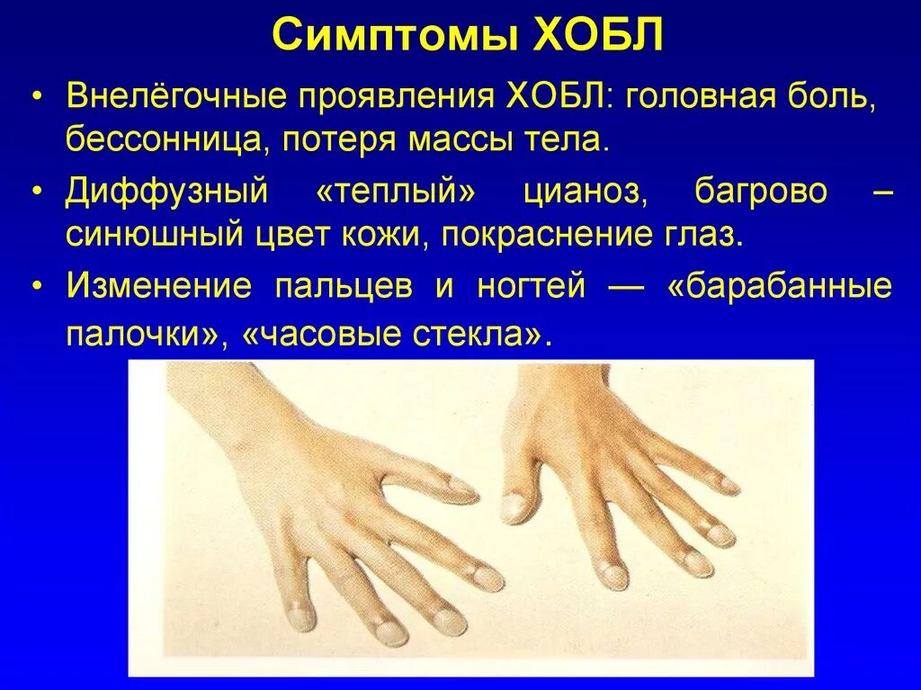 Болезнь хобл симптомы и причины что это. Признаки хобл. хобл проявляется признаками. барабанные палочки при бронхиальной астме.
