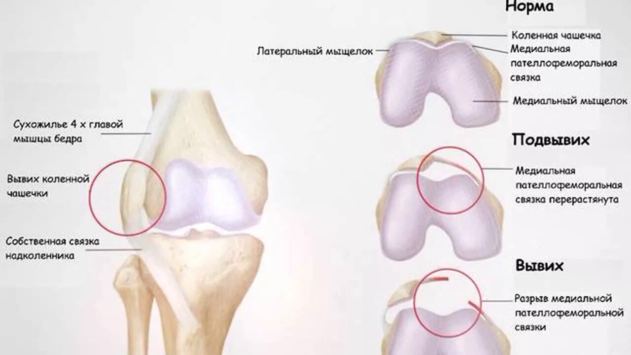 Повреждение медиального мыщелка. Вертикальный вывих надколенника рентген. Подвывих коленной чашки. Медиальный подвывих коленной чашечки. Врожденный вывих надколенника рентген.