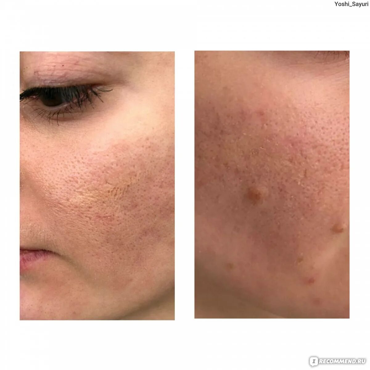 Laser Wrinkle Removal Los Angeles Sale xn--h1aahyg1df.xn--p1ai