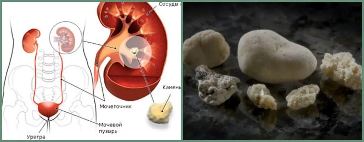 Вышел камень из мочеточника у мужчин. Мочекаменные болезни уратные камни. Почечные камни симптомы. Уратные камни в мочеточнике. Камни в почках и мочевом пузыре.
