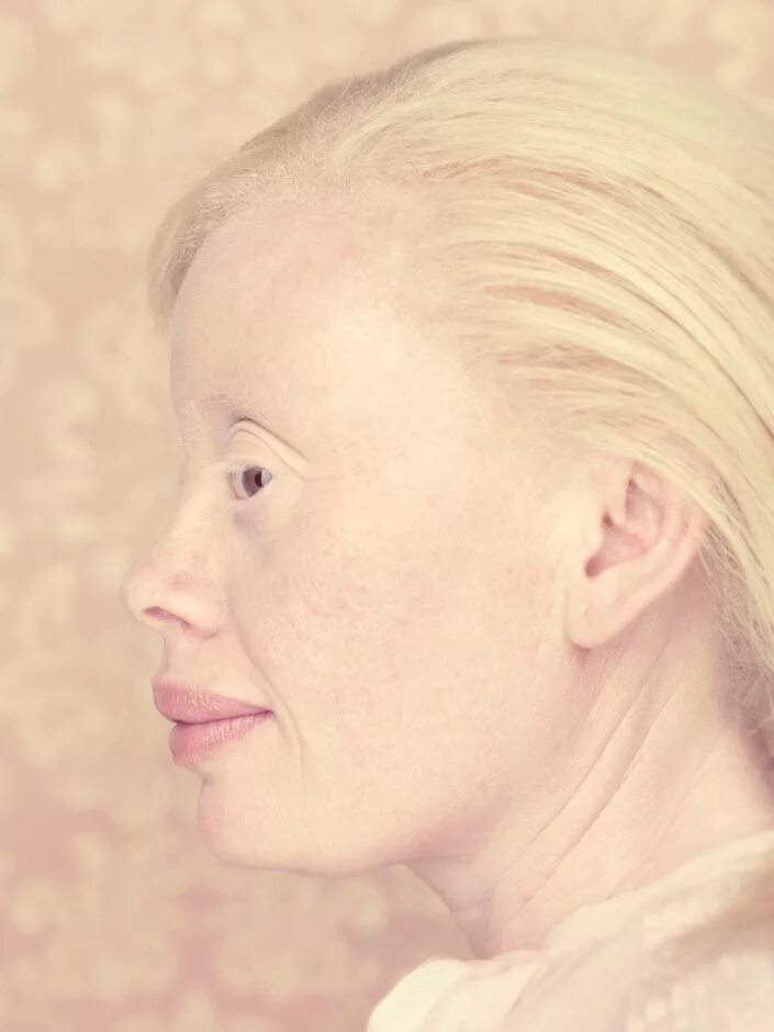 Сестры калагановы альбиносы. Настя жидкова альбинос. Амина эпендиева сестры альбинос. Нарияна якутская белоснежка. Глазно-кожный альбинизм.