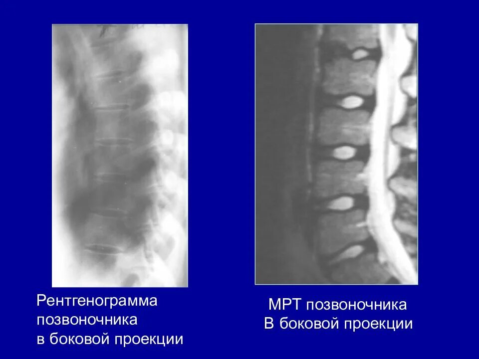 Рентгенография позвоночника в 2 х проекциях. Позвоночника в боковой проекции. Рентгенограмма позвоночника в боковой проекции. Рентген позвоночника в двух проекциях. Рентген позвоночника сбоку.