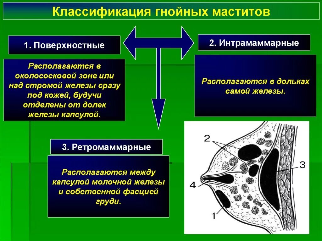 Классификация локализации маститов. Классификация острого мастита. Мастит классификация по локализации. Ретромаммарный мастит локализация. Острый гнойный мастит