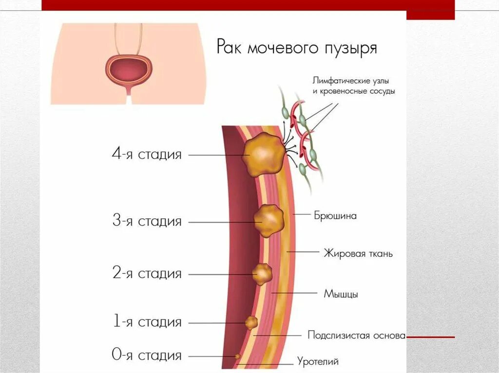 Рак мочевого сколько живут