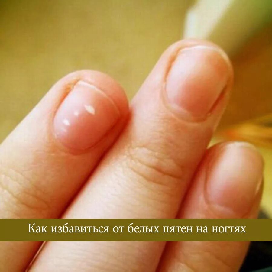 Что значит белые пятна на ногтях. Белые пятна на ногтях у ребенка. белые точки на ногтях у ребенка.