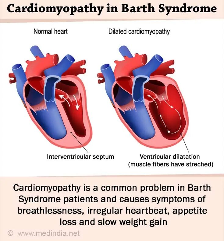 Синдром Барта–Памфри (BPS). Bart-Pumphrey Syndrome; baps. Синдром Барта-Памфри фото. Синдром барта