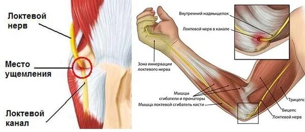 Медиальный надмыщелок локтевого сустава анатомия. Локтевой нерв на предплечье. Локтевой нерв анатомия. Локтевой нерв иннервирует мышцы. Кубитальный туннельный синдром.