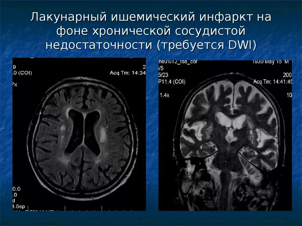 Сосудистый характер головного мозга fazekas. Острый рассеянный энцефаломиелит мрт. Лейкоареоз на кт. Васкулит головного мозга мрт. Мрт головного мозга при сосудистой деменции.