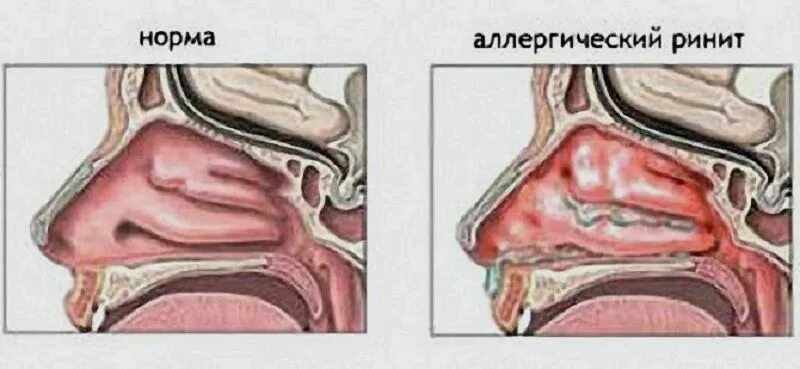 Задний насморк