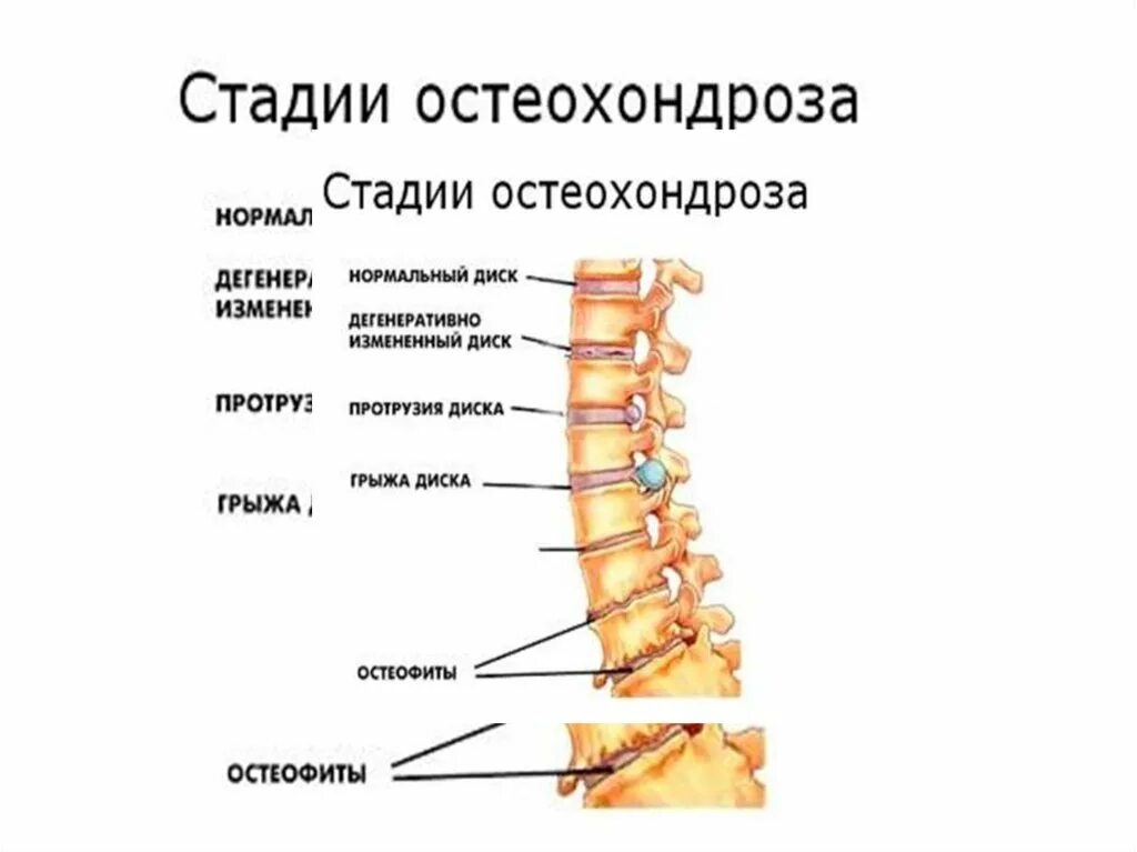 Остеохондроз шейного отдела позвонка 1-2 стадий. Остеохондроз поясничного отдела 2-3 стадии. Степени остеохондроза поясничного отдела. Остеохондроз 1-2 степени грудного отдела.