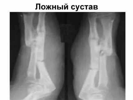 Ложный сустав