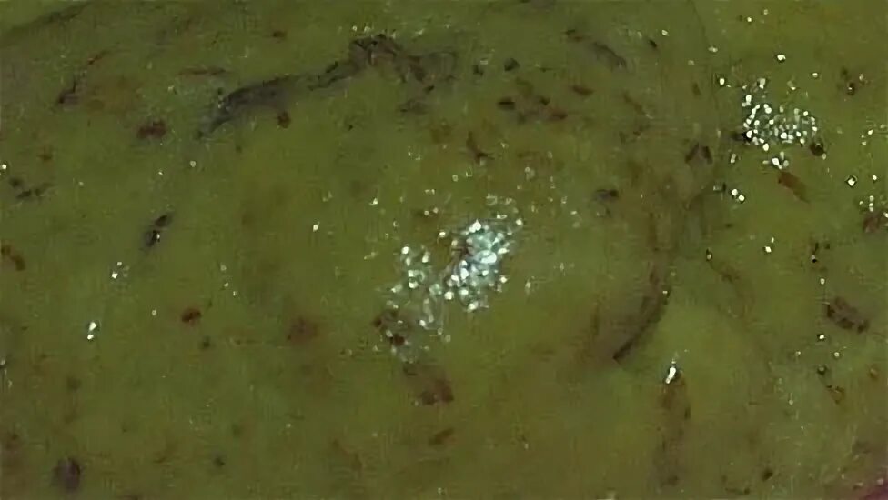Рвота понос сыпь