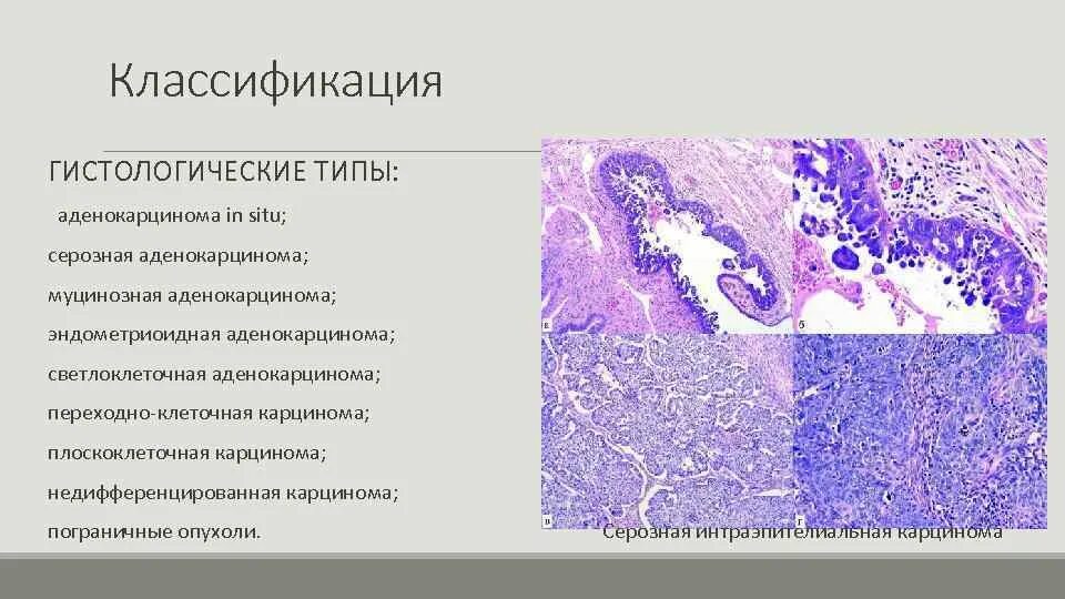 G1 опухоли. Гистологические типы аденокарциномы. Светлоклеточная аденокарцинома гистология. Серозная цистаденофиброма гистология. Аденокарцинома маточной трубы гистология.