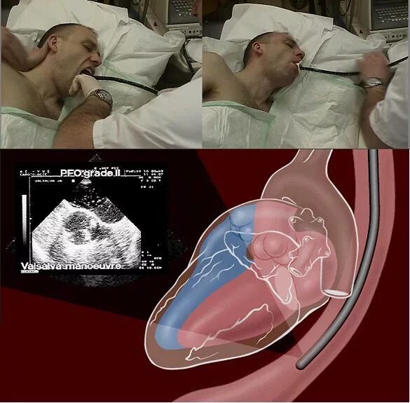 Чреспищеводное УЗИ сердца. Чреспищеводная эхокардиоскопия. Чреспищеводная эхокардиография. Эхокардиография через пищевод.