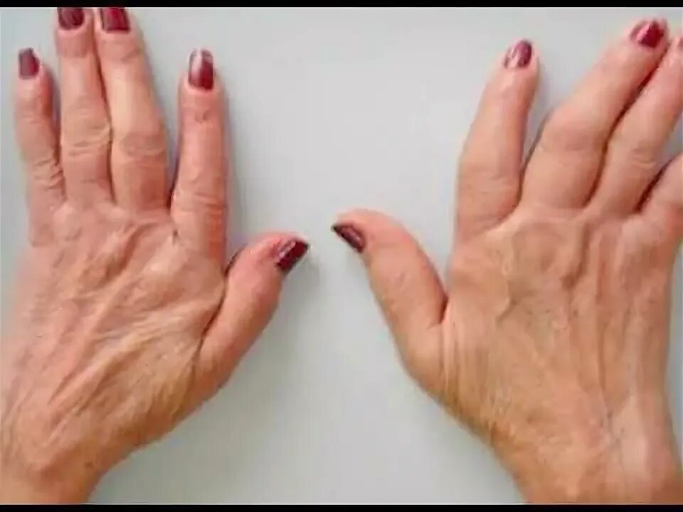 Серопозитивный ревматоидный полиартрит. Полиартроз неуточненный. Полиартроз неуточненный. Полиартроз суставов кистей. Полиартроз неуточненный.