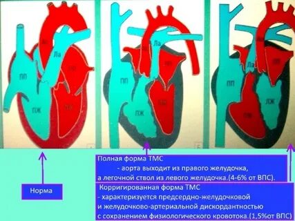 Корригированная транспозиция магистральных сосудов