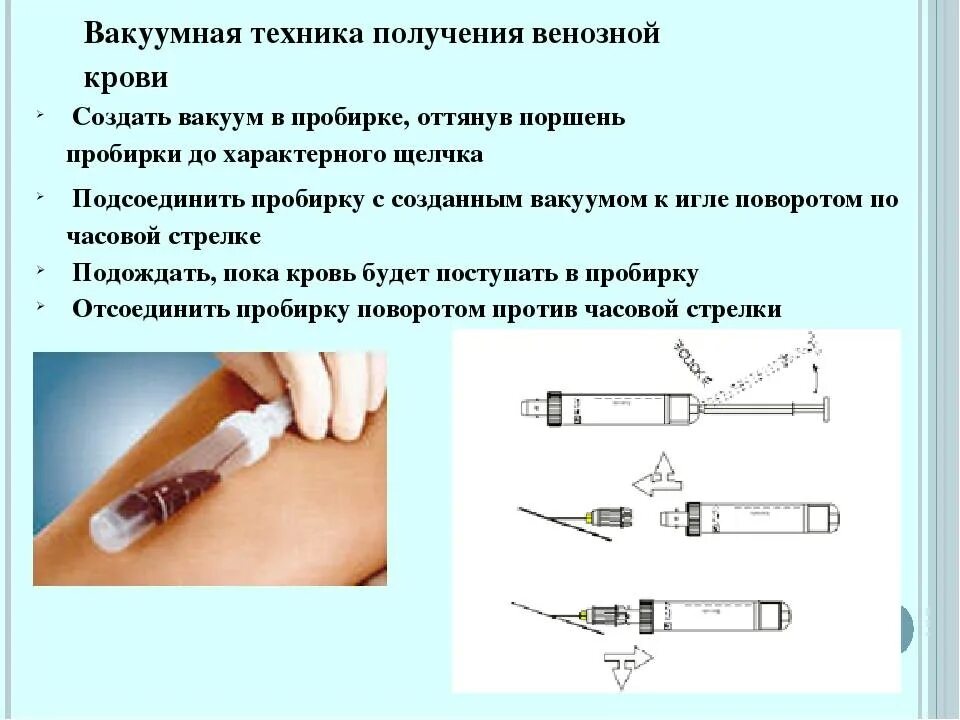 Почему сворачивается кровь из вены. Взятие крови из вены вакуумной системой забора крови. Кровь из вены вакуумной системой алгоритм. Внутривенный забор крови алгоритм. Забор крови из вены вакуумной системой алгоритм.