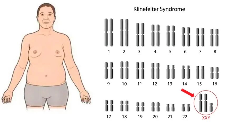 Синдром Клайнфельтера кариотип. Синдром Клайнфельтера 47 xxy. Гинекомастия Клайнфельтера. Q98.0 синдром Клайнфелтера, кариотип 47,xxy. Синдром клайнфельтера наследственное