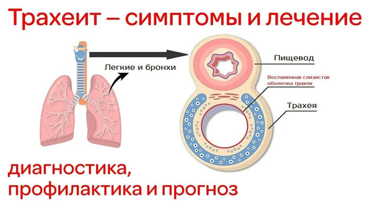 Украл девушку и трахеит. Чем лечить трахеит у ребенка. Трахеит клинические проявления. Украл девушку и трахеит. Украл девушку и трахеит.