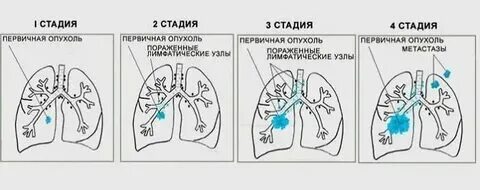 Как распознать рак на ранней стадии симптомы