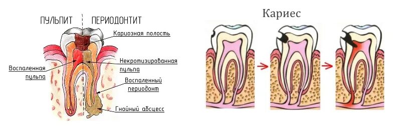 Классификация кариес пульпит периодонтит. Апикальный периодонтит. Осложнение лечения периодонтита