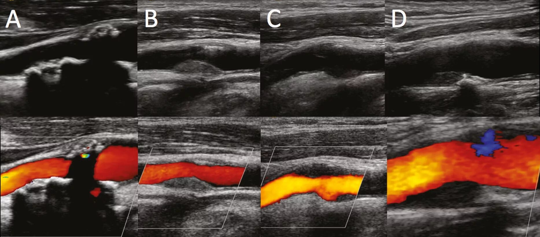 Нестенозирующий атеросклероз бца что это. Стеноз сонной артерии УЗДГ. Стеноз сонных артерий на УЗИ. Атеросклероз сонных артерий УЗИ. УЗИ стенозов брахиоцефальных сосудов.