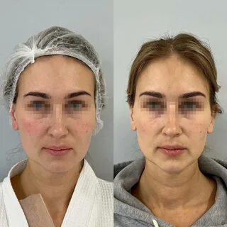Липосакция лица