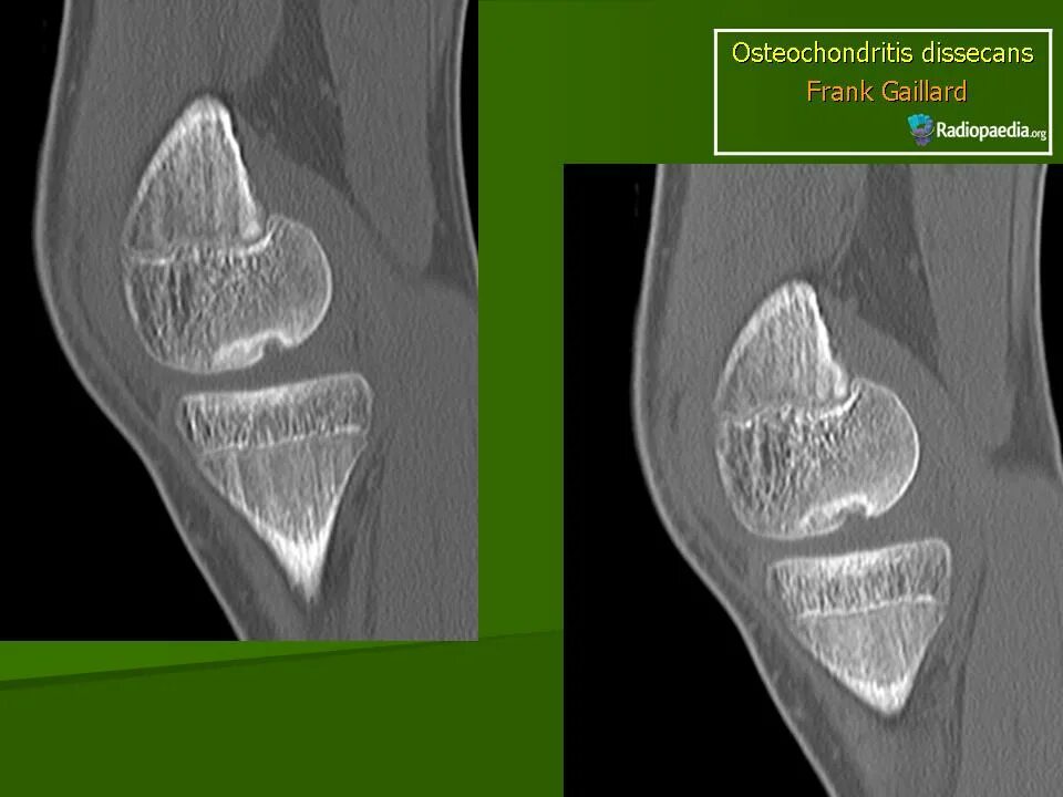 Асептический некроз мыщелка. Рассекающий остеохондрит кт. Рассекающий остеохондрит рентген. Остеохондрит коленного сустава. Рассекающий остеохондрит мрт.