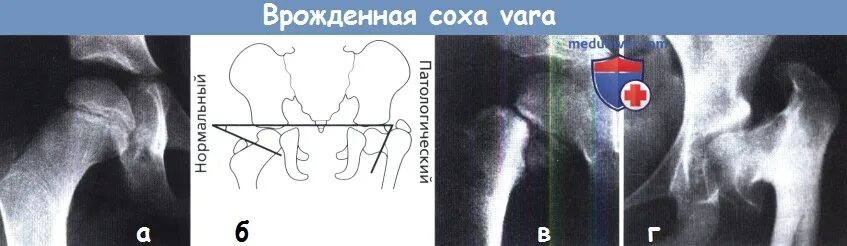 Варусная деформация код мкб. Варусная деформация тазобедренного сустава. варусная деформация шейки бедренной кости. варусная деформация шейки бедра. врожденная варусная деформация шейки бедра.