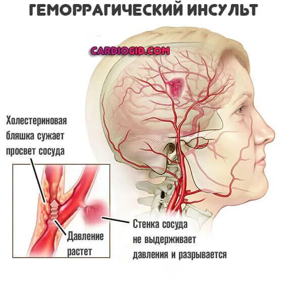 Сужение сосудов повышение давления. Клинические проявления геморрагического инсульта. Инсульт геморрагический разрыв сосуда и кровоизлияние. Ґоморрогический инсульт. Gemorragiki insult.