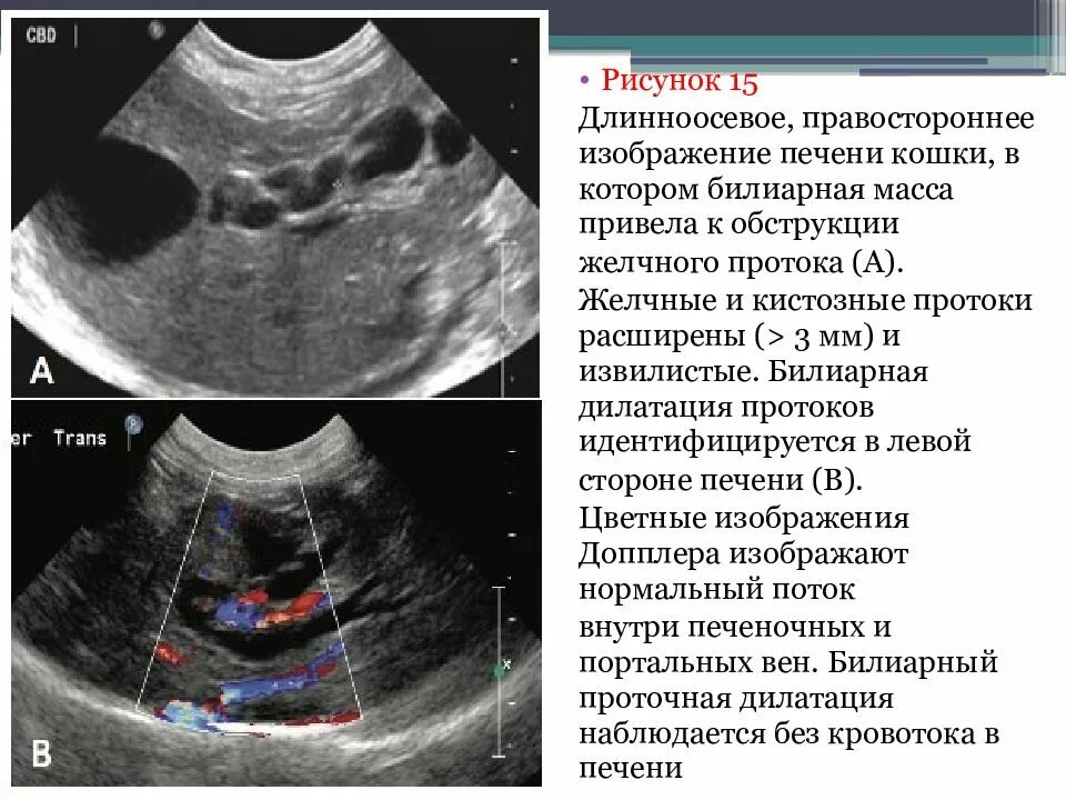 Узи печени и желчного пузыря. Желчные протоки расширены на УЗИ. Расширение желчных протоков на УЗИ. Расширение печеночных протоков на УЗИ. Общий желчный проток норма на УЗИ.