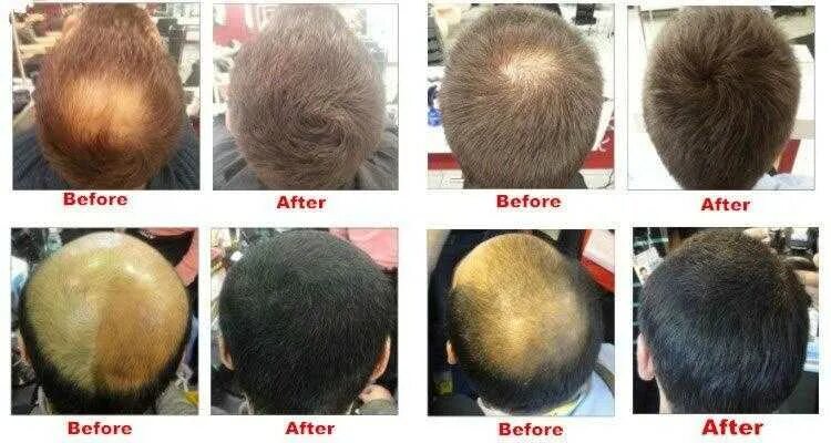 За сколько отрастают волосы у мужчин. Финастерид при алопеции до и после. Финастерид 1мг от облысения. Финастерид от выпадения волос для мужчин. Эсвицин андрогенная алопеция.
