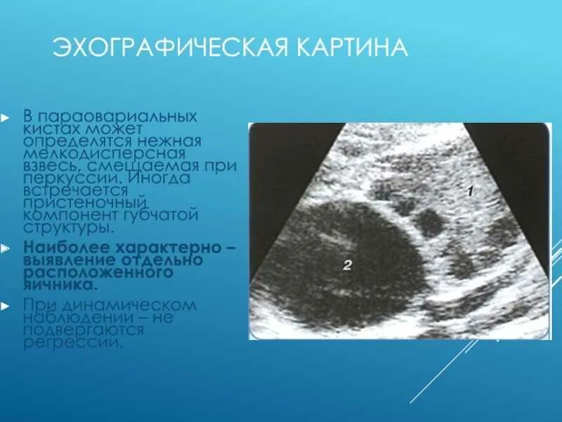 Надо ли удалять параовариальную кисту. Эхографическая картина. Киста желтого тела с мелкодисперсной взвесью. Мелкодисперсная взвесь в кисте яичника что это.